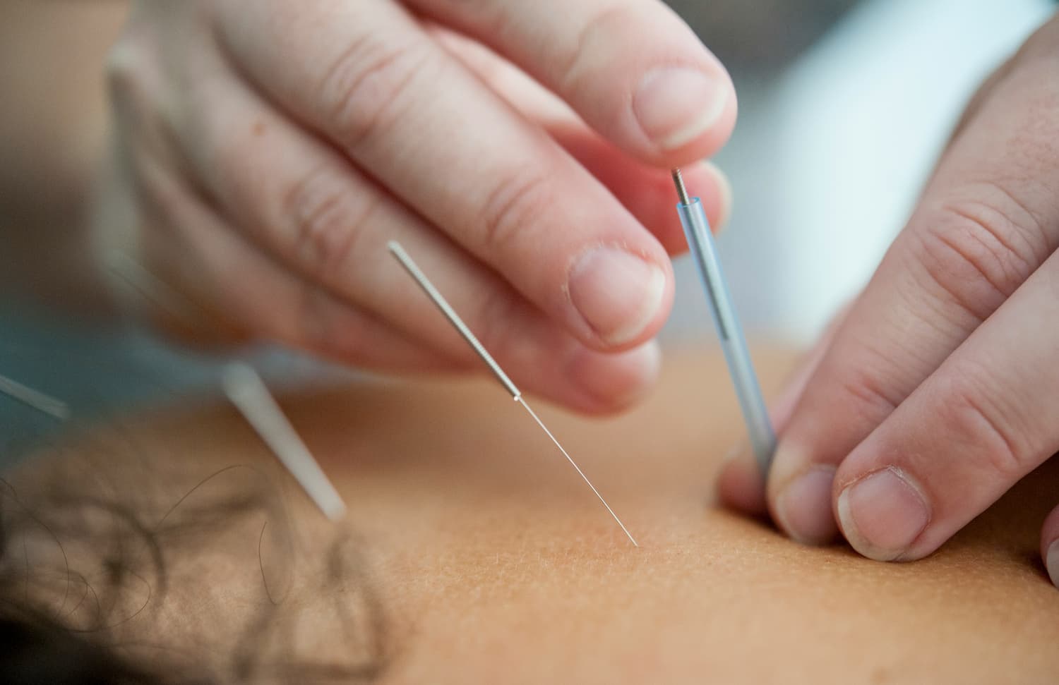 Applying acupuncture needles in back