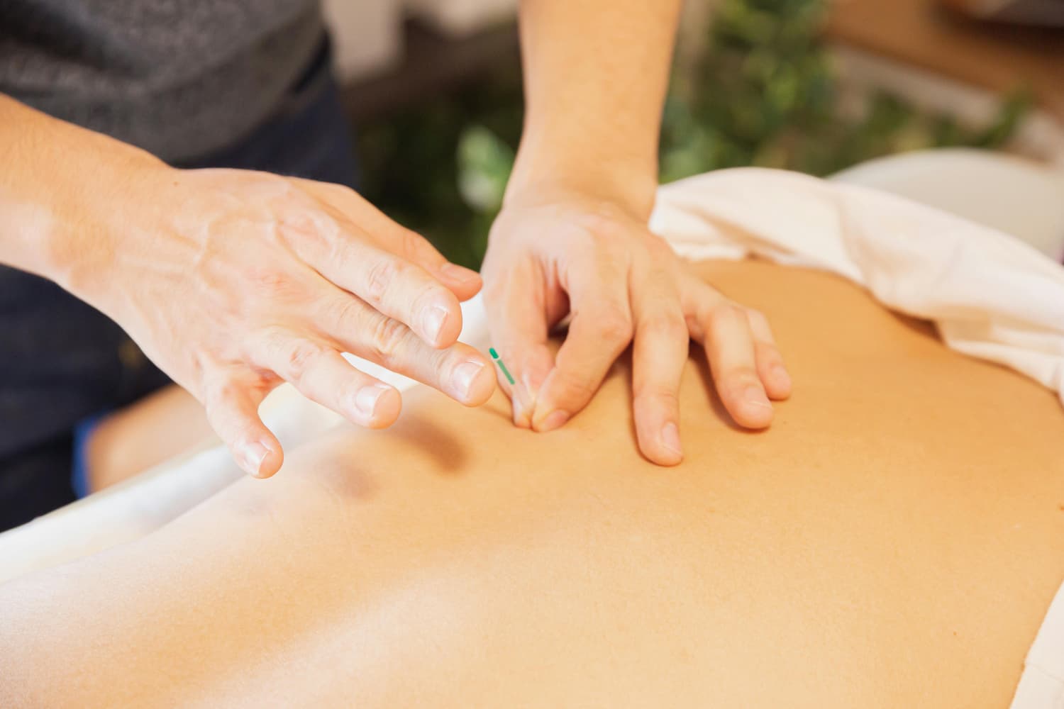Acupuncture on back