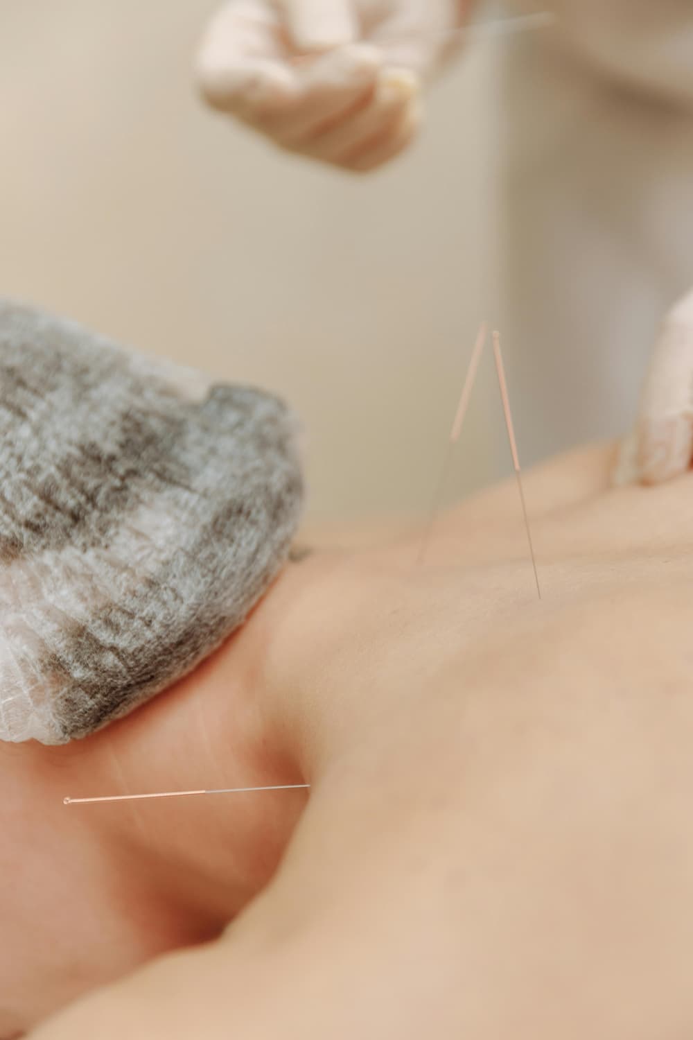 Acupuncture needles applied to the back and shoulders